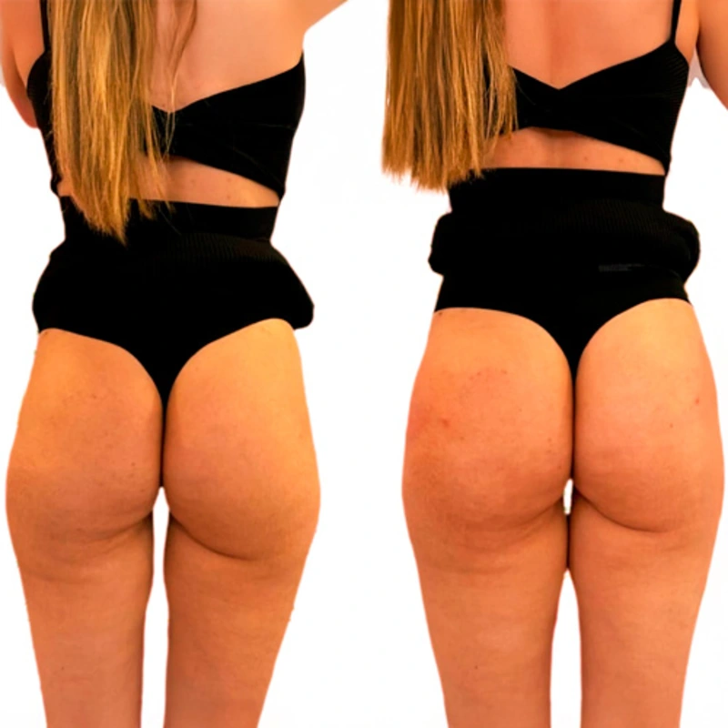 Antes e depois — resultado de preenchimento de glúteos (modelo 2)