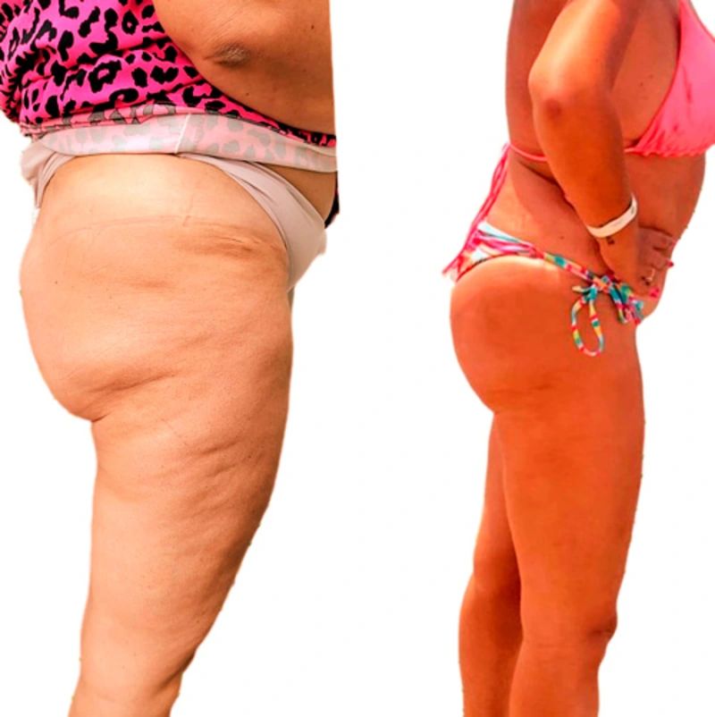 Antes e depois — resultado de preenchimento de glúteos (modelo 3)